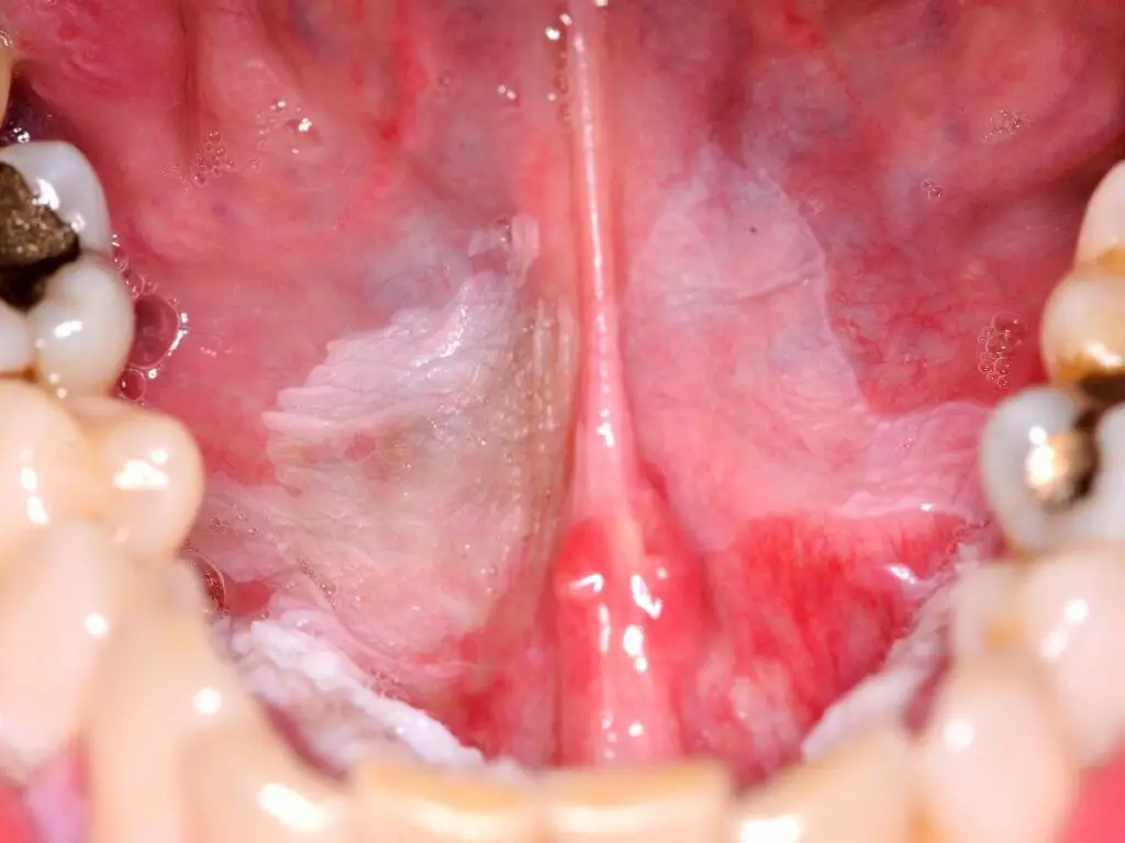 Today we take time to examine leukoplakia in more detail, a white abnormality of the oral mucosa