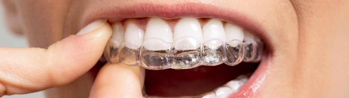 Op de foto ziet u hoe een transparant bitje precies over de tanden wordt geplaatst en naadloos aansluit op de tandrij. Dit beeld illustreert hoe een bitje op maat maken in een moderne tandartspraktijk verloopt, waarbij digitale gebitsafdrukken en hoogwaardige kunststoffen samenkomen. Het maatwerk mondstuk biedt niet alleen optimale gebitsverzorging, maar versterkt ook de esthetische tandheelkunde door een onzichtbare en comfortabele pasvorm. Zo benadrukt deze visuele weergave het belang van een persoonlijk afgestemde splint of gebitsbeschermer voor preventie en mondzorg.